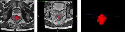 Predicting the risk of distant metastasis in patients with locally advanced rectal cancer using model based on pre-treatment T2WI-based radiomic features plus postoperative pathological stage